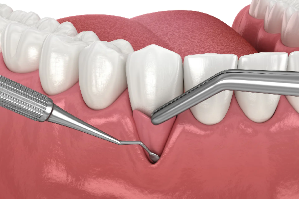 Periodontal Surgeries