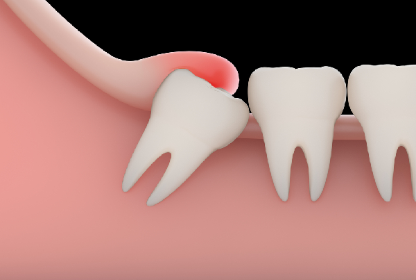 Minor Oral Surgery